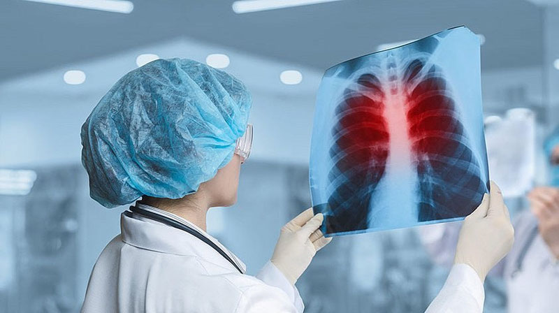 'Туберкулёз йилига 1 миллиондан ортиқ кишининг ўлимига сабаб бўлмоқда — ЖССТ'ning rasmi